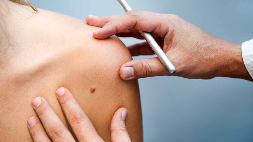 Un neo sospetto non va mai sottovalutato. Rivolgersi subito al dermatologo può salvare la vita